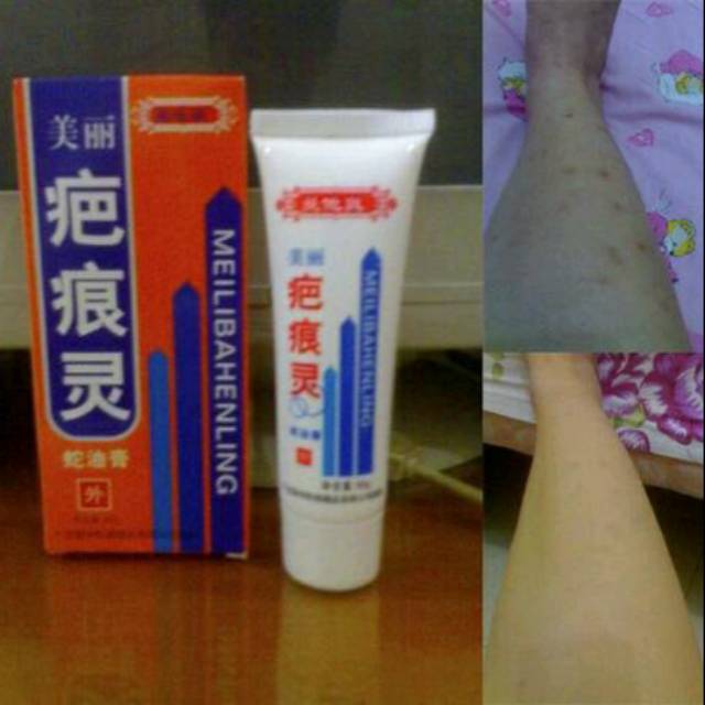 Obat Penghilang Bekas Luka Cacar Flek Jerawat dll-Meilibahenling Asli Cream