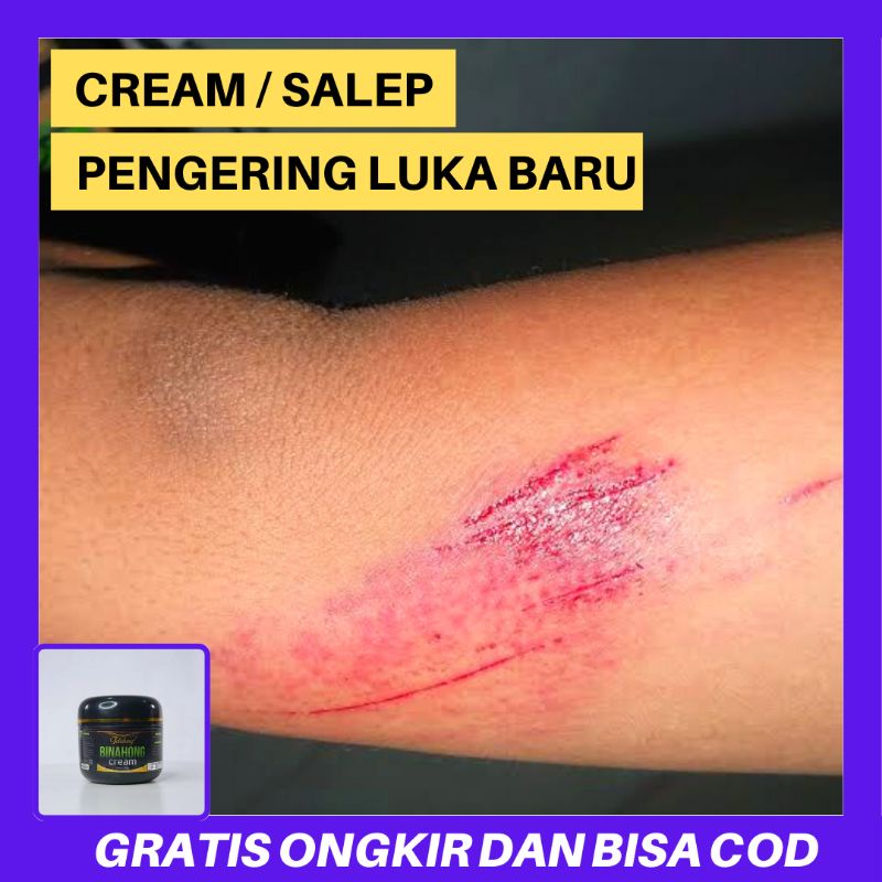 Cream Luka Agar Cepet Kering - Cream Salep Obat Luka Bekas Jatuh - Crem Binahong Untuk Obati Luka Go