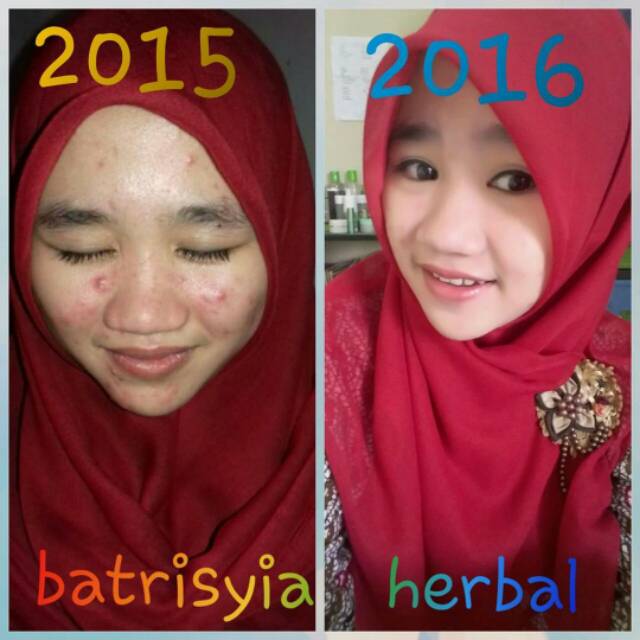 Serum anti acne 25ml obat jerawat batrisyia herbal