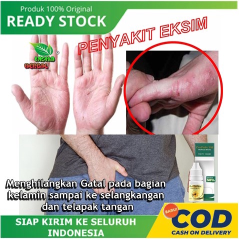 PROPOLIS SM Berkhasiat Untuk Menghilangkan Gatal pada bagian kelamin sampai ke selangkangan dan tela