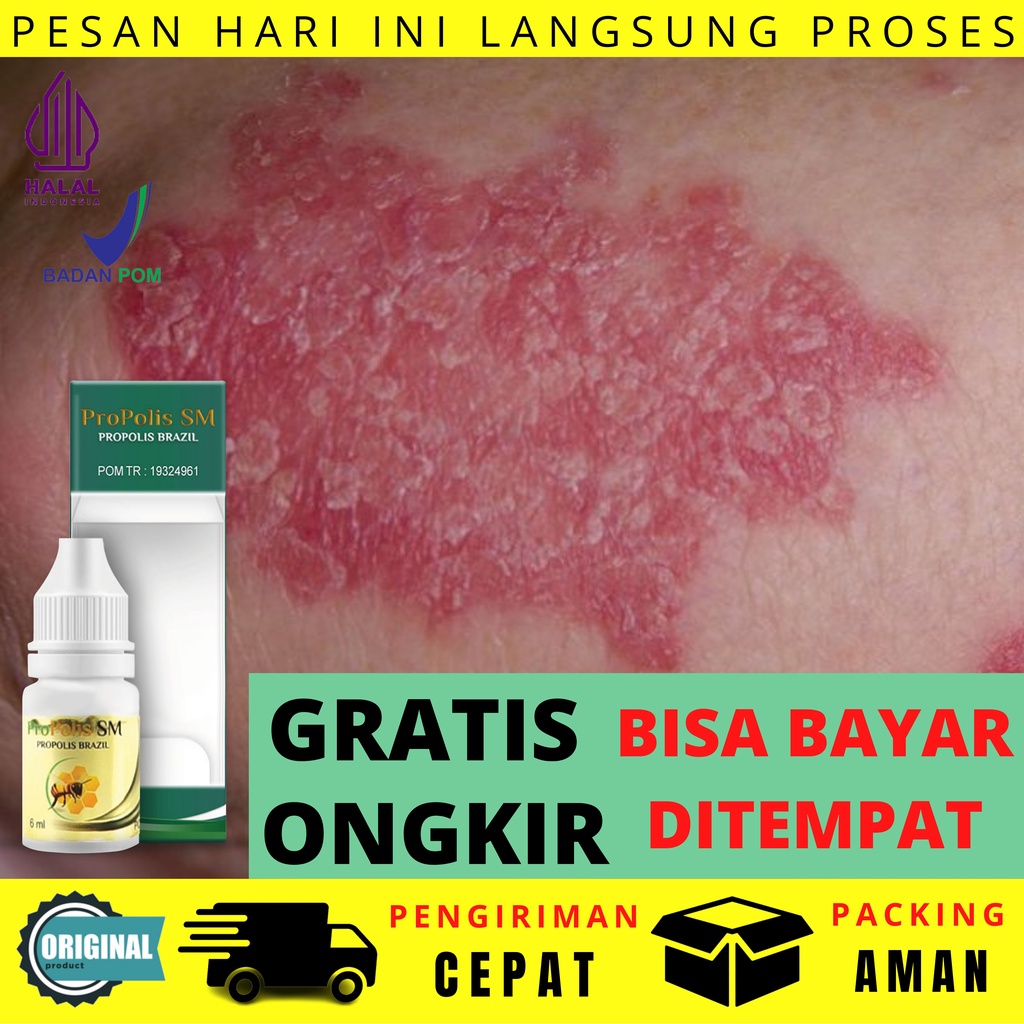 Obat Psoriasis Kulit Kepala Lutut Siku Punggung Bagian Bawah Alami Kuku Tebal Menebal Berjamur Berlu