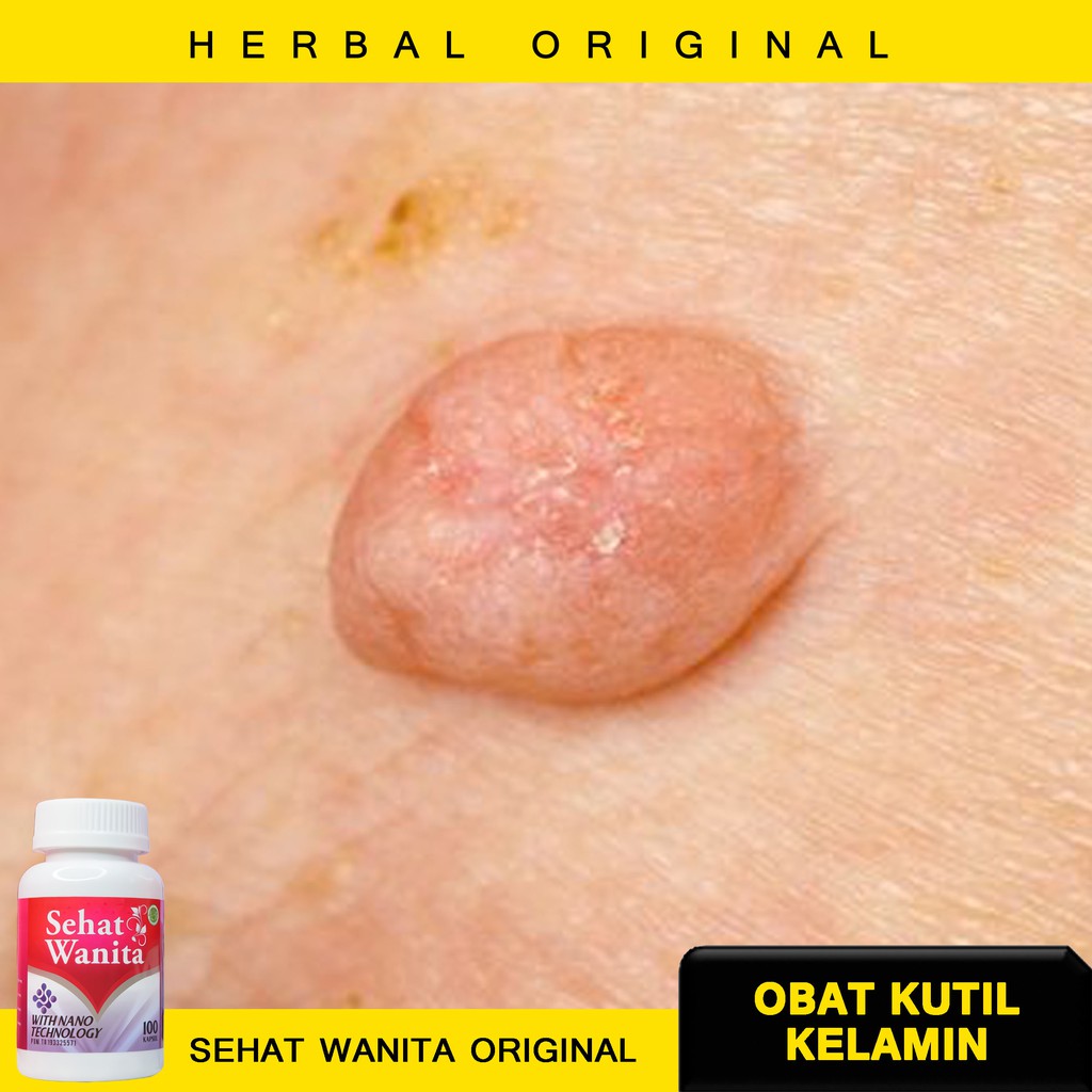 OBAT KUTIL KELAMIN WANITA BerBPOM - Obat Daging Menonjol di Kewanitaan dgn SEHAT WANITA ORIGINAL
