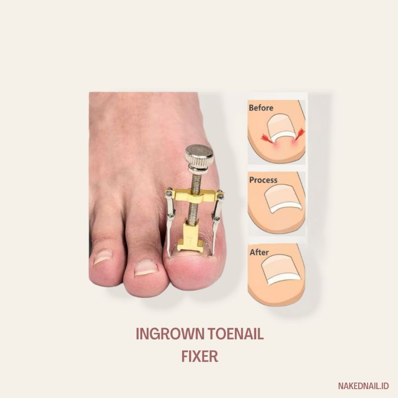 korektor jempol kuku kaki toenail ingrown correction toenail fixer