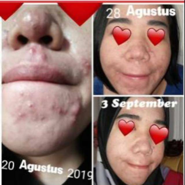 (Official) DAVIENA SKINCARE ACNE SERIES | DAVIENASKINCAREPUSAT-2