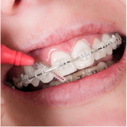 interdental brush ortho