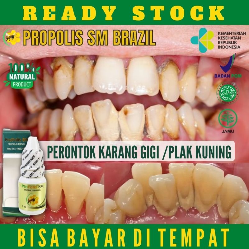 PERONTOK KARANG GIGI, Pembersih Plak Gigi Kuning Membandel, Penghilang Karang Gigi dan Plak Flak Gig