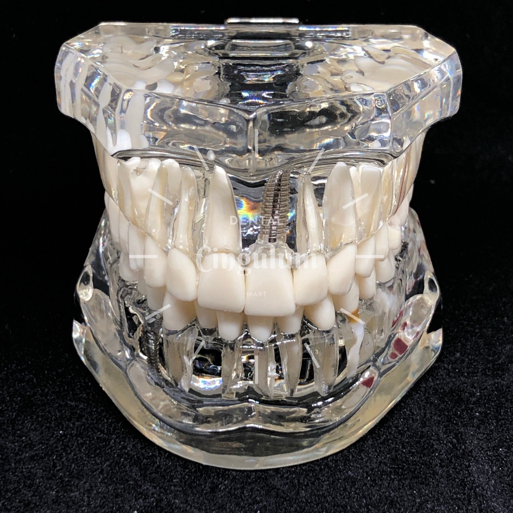 Model Gigi / Phantom Gigi / Model Gigi Implan / Phantom Gigi Implan / Phantom Gigi All in One / Phan