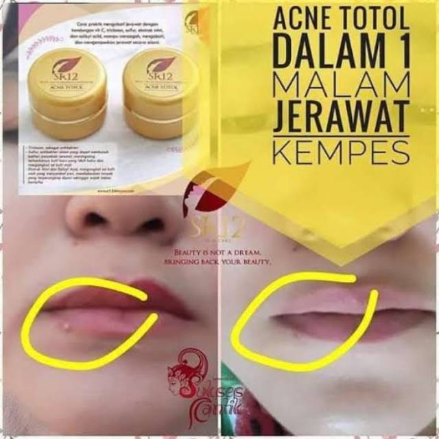 ACNE TOTOL/OBAT JERAWAT/JERAWAT BESAR/JERAWAT BATU
