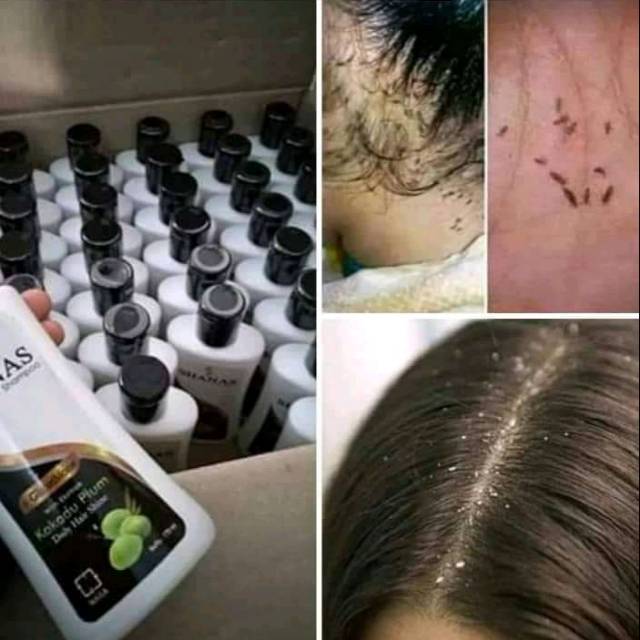 Sampo shanas nasa anti kutu&ketombe