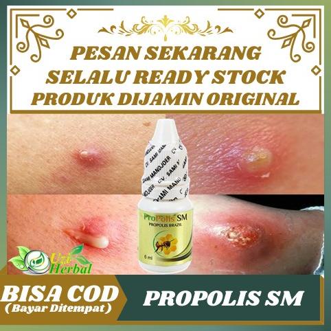 Obat Bisul Kelamin, Bisul Di Kemaluan Pria Dan Wanita Herbal Propolis