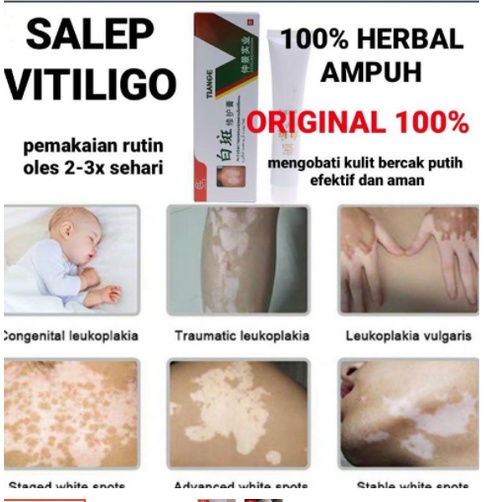 READY SALEP VITILIGO ORI 100% SEMBUH Tiange Cream Psolaren Solaren Import