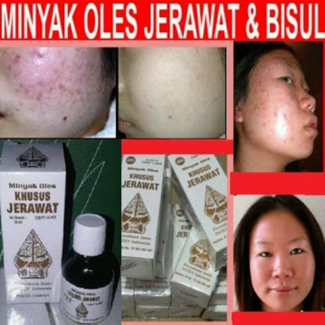 Minyak Oles Obat Jerawat Cap Wayang Original Obat Jerawat Paling Ampuh Shopee Indonesia