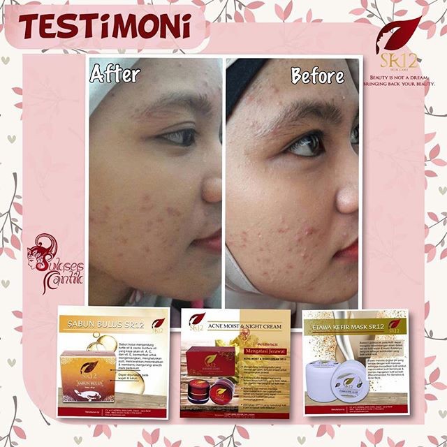 KRIM TUMPAS JERAWAT BPOM ACNE MOIST CREAM SR12 BEKAS JERAWAT MENCERAHKAN WAJAH KERUTAN WAJAH