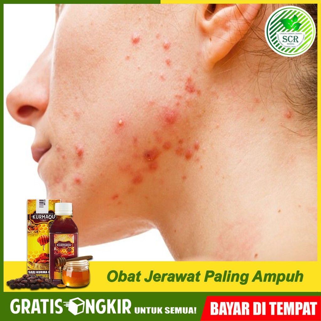 Obat Jerawat Di Wajah Bekas Jerawat Bopeng Herbal Terbaik Kurmaqu Sari Kurma Madu 100 Asli Indonesia