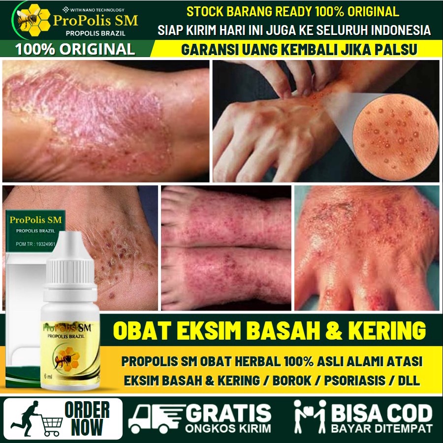 Obat Eksim Herbal 100% Asli Alami, Atasi Eksim Basah & Kering, Eksim Bernanah, Eksim Gatal Menahun, 