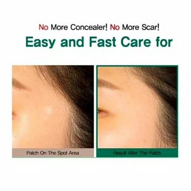 (Share 1pcs) SOME BY MI 30 Days Miracle Clear Spot Patch