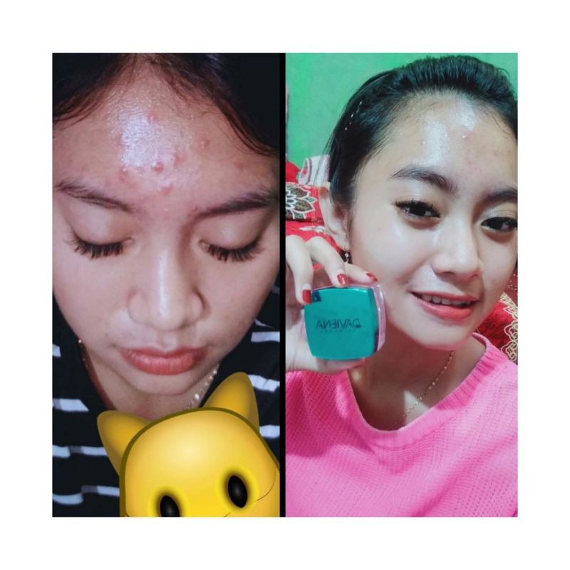 [Official] ACNE SERIES|CREAM JERAWAT AMPUH BPOM DAVIENA SKINCARE|Daviena Skincare