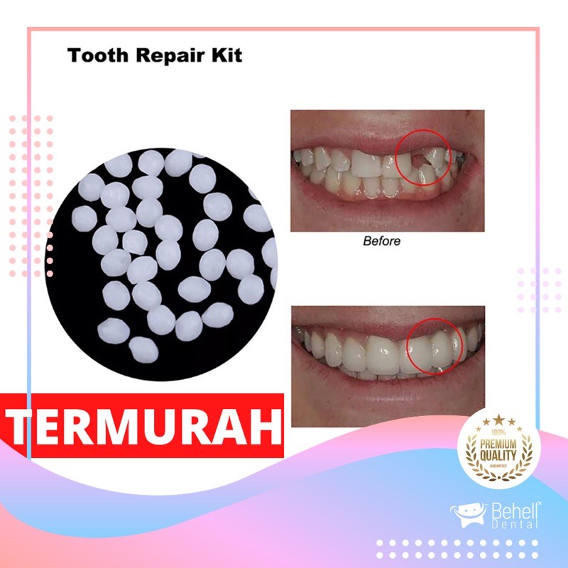 TERMURAH !! 1000 BUTIR TEMPTOOTH GIGI PALSU SEMENTARA PENAMBAL GIGI PATAH RENGGANG / TEMTOOTH / BAHAN TAMBAL GIGI BOLONG BERLUBANG / TEMPORARY TOOTH INSTAN PRAKTIS / TEMPTOOTH GINGSUL PATAH LEM TIRUAN MURAH ORIGINAL ISI 200 / 500 / 400 / 150 / 100 BUTIR