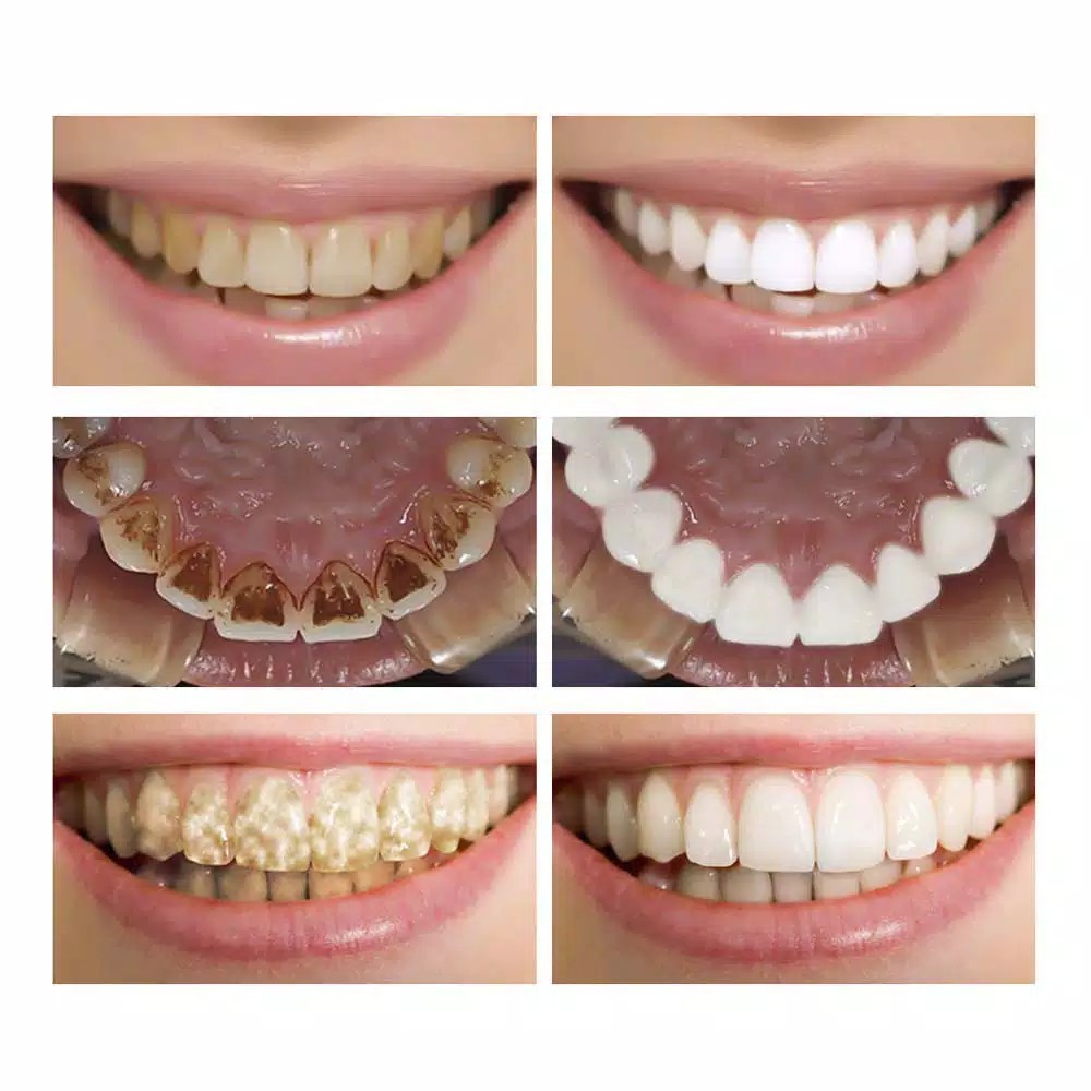 Pemutih Gigi Kuning Kerak Penghilang Karang Permanen Original Ampuh Teeth Whitening Odol Pasta Bpom