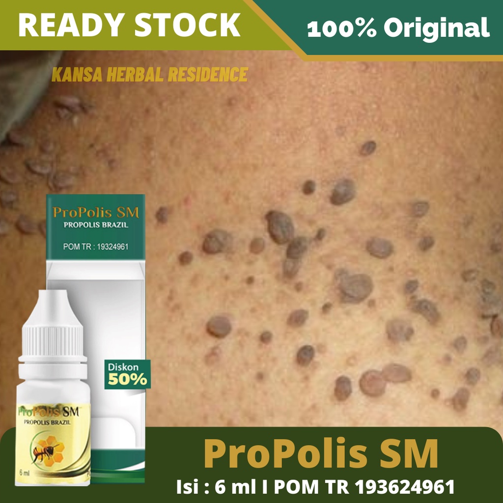 Obat Salep Penghilang Kutil - Kelamin - Kepala - Selangkangan - Leher - Tangan - Kutil di Ketiak | Obat Virus Hpv Herbal Propolis SM Brazil