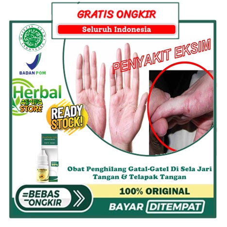 Obat Penghilang Gatal-Gatel Di Sela Jari Tangan, Penghilang Gatal Di Jari Tangan, Penghilang Gatal d
