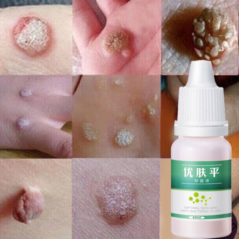 Obat kutil Obat mata ikan Cairan Anti KutilTangan Dan Kaki Menghilangkan Kutil &amp; Skin Tag Cairan Antibakteri Obat