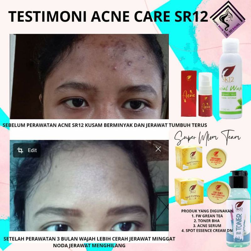 SERUM JERAWAT BPOM AMPUH..!! ACNE SERUM SR12 / OBAT PENGHILANG JERAWAT / SERUM RADANG JERAWAT