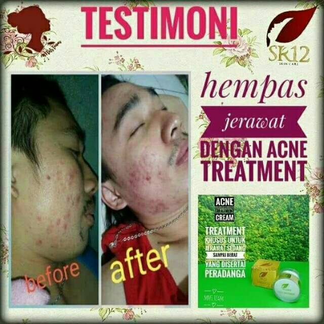 Acne Treatment Cream SR12 Penghilang Noda Bekas Jerawat Luka Stretch Mark