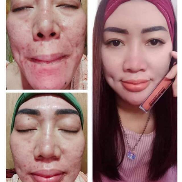 Paket Acne Drw skin care