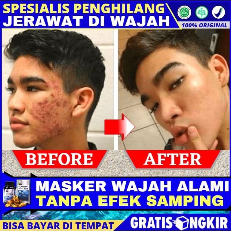 Masker Wajah Berjerawat Alami Obat Jerawat Komedo Bruntusan Penghilang Bekas Bopeng Flek Hitam Memba