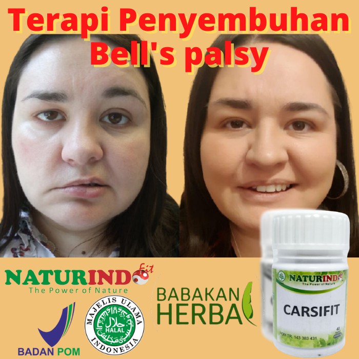 Obat Bells Palsy Herbal Untuk Penyakit Bell S Palsy Obat Wajah Kaku Sebelah Dan Melorot Shopee Indonesia