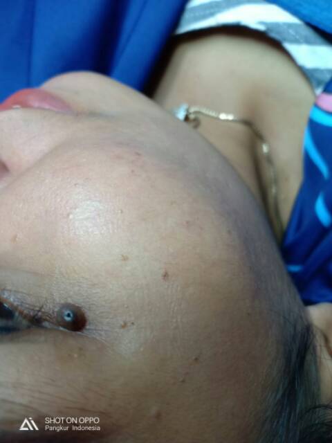 Picosecond alat laser penghilang flek bekas jerawat tato tai lalat kutil black spot mole removal