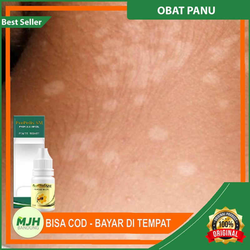 Obat Penghilang Panu di Wajah, Leher, Punggung - Hapur di Sekujur Tubuh - Hapuran - Kadas - Kurap