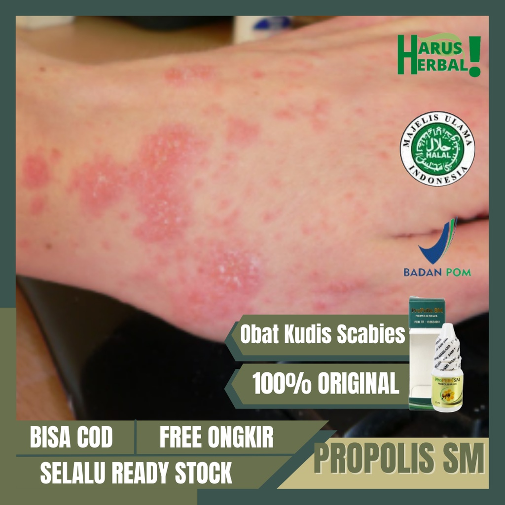 Obat Kudis Herbal, Obat Scabies Manusia, Obat Kudis Skabies, Obat Kudis Gatal, Obat Kulit Gatal, Oba
