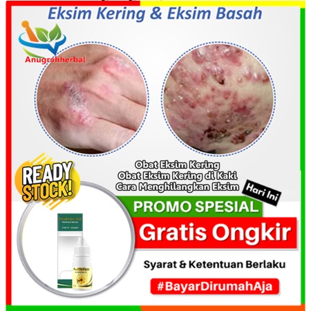 Obat Eksim Kering, Obat Eksim Kering di Kaki, Cara Menghilangkan Eksim, Salep Gatal Eksim Kering, He