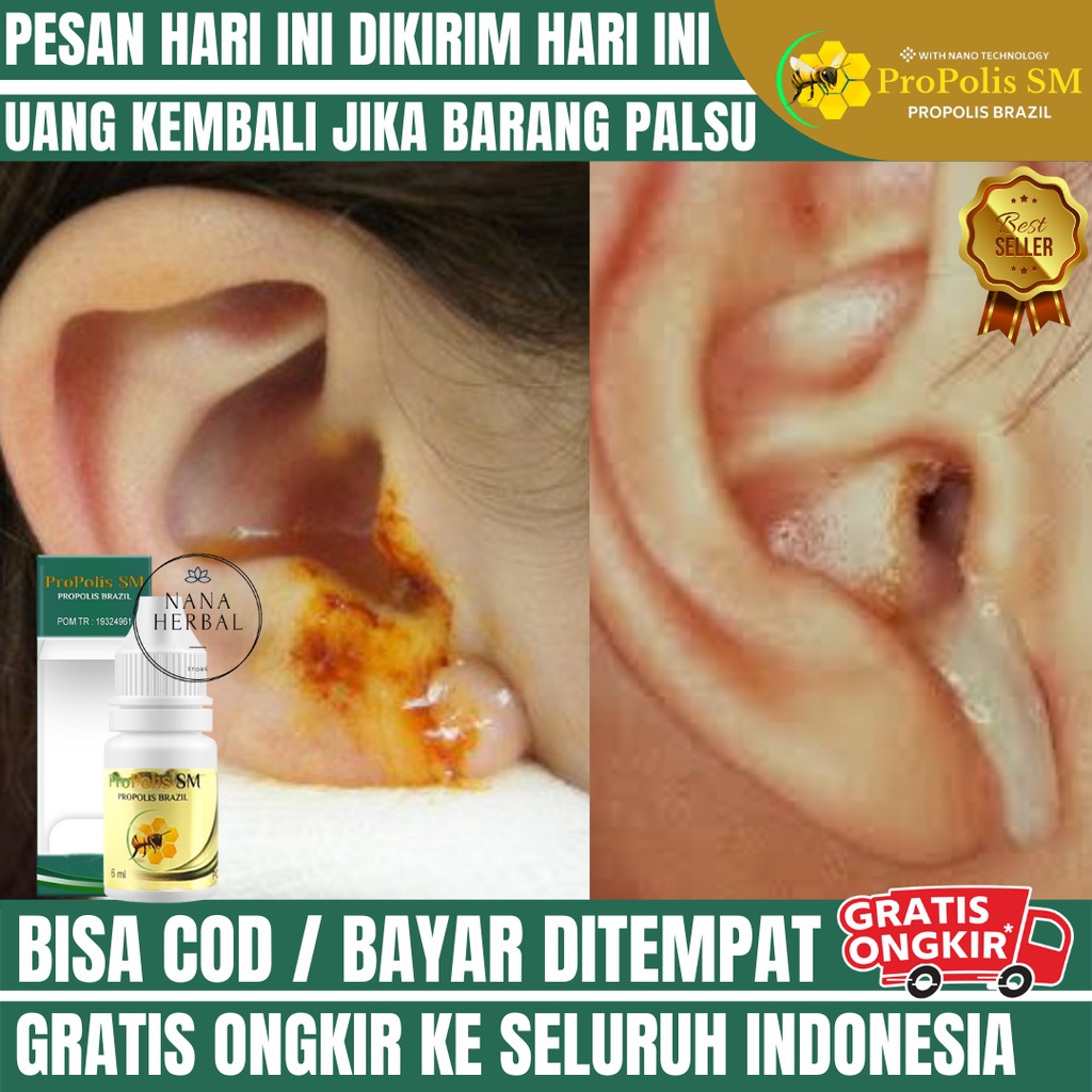 Obat Gatal Telinga Berair Dan Bernanah, Obat Sakit Telinga Dalam, Obat Sakit Telinga Berair Dan Saki