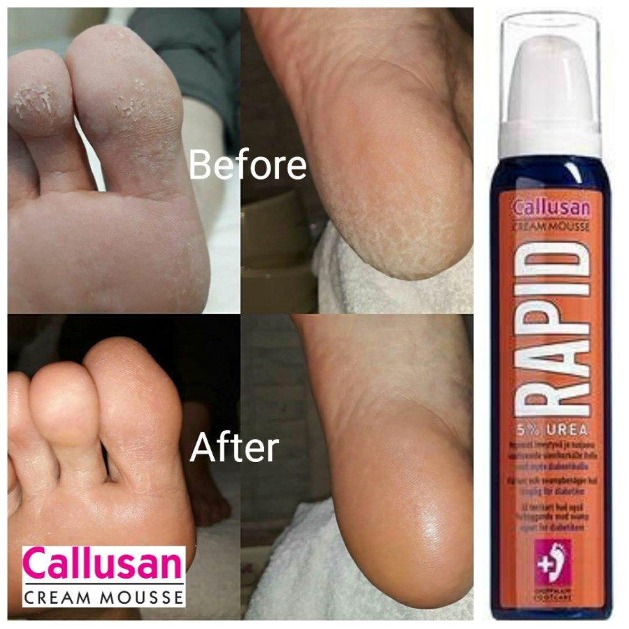 Rough Skin Kapalan Callusan Cream Mousse Rapid Foam Non Krim 125ml Non Gehwol Pedicure