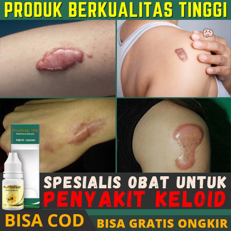 Obat Penghilang keloid Daging Jadi/Tumbuh Menonjol Tahunan Skin Tag Kutil Kelamin Bekas Operasi Jahi