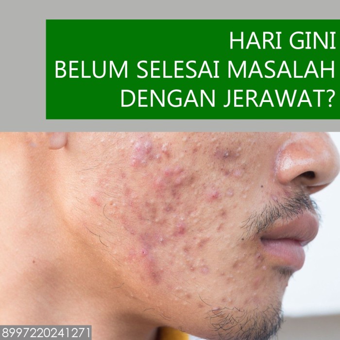 Whitelab WL Acne Calming Serum menghilangkan jerawat