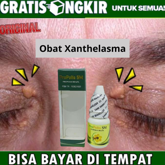 Propolis SM Obat Herbal Gumpalan lemak Di Kelopak Mata / Xanthelasma