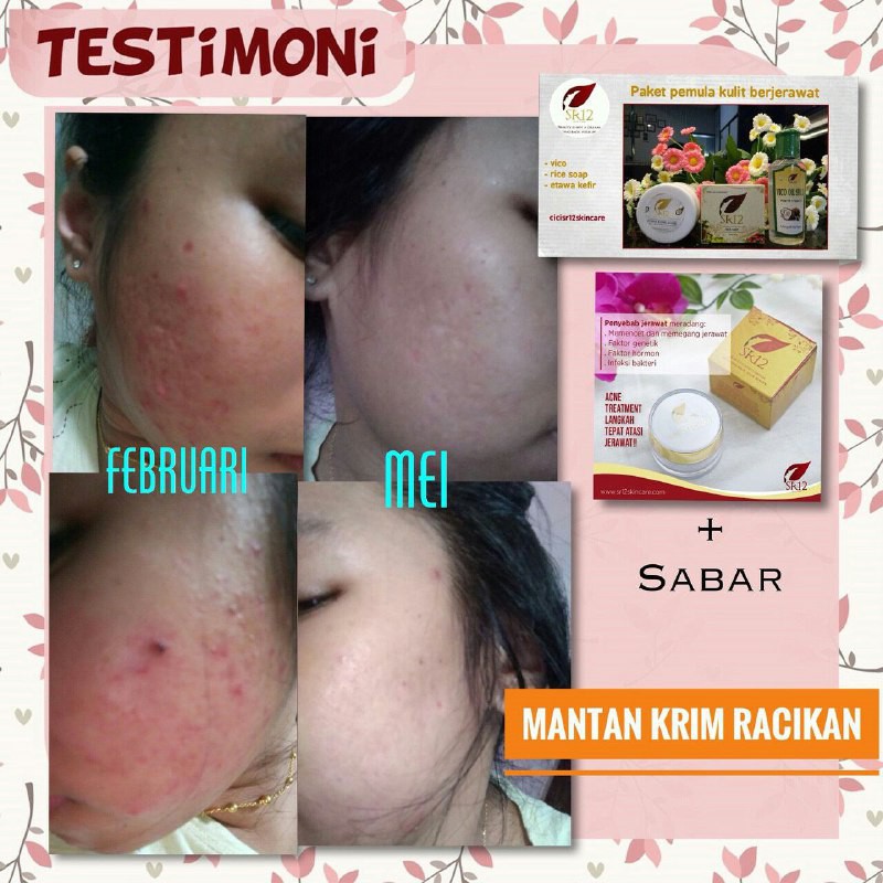 SR12 ACNE TREATMENT CREAM KRIM JERAWAT MERADANG &amp; MEMBANDEL AMPUH HILANGKAN JERAWAT