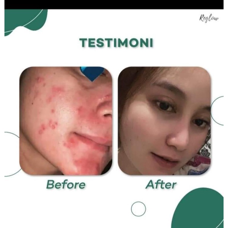 REGLOW GLOWING Skin Treatment skincare BPOM Reglow glow skin treatment reglow skincare original kulit berminyak kulit sensitif skin care reglow beauty dr shindy putri skincare viral cream pemutih wajah skincare pria cream flek hitam membandel paket glowin-8