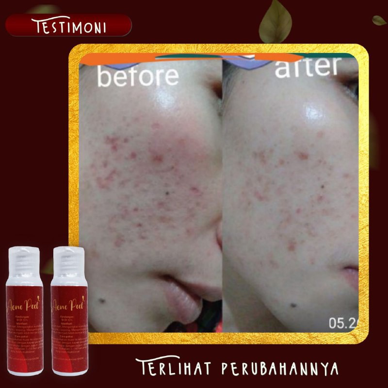 ACNE PEEL SR12 / PEELING WAJAH