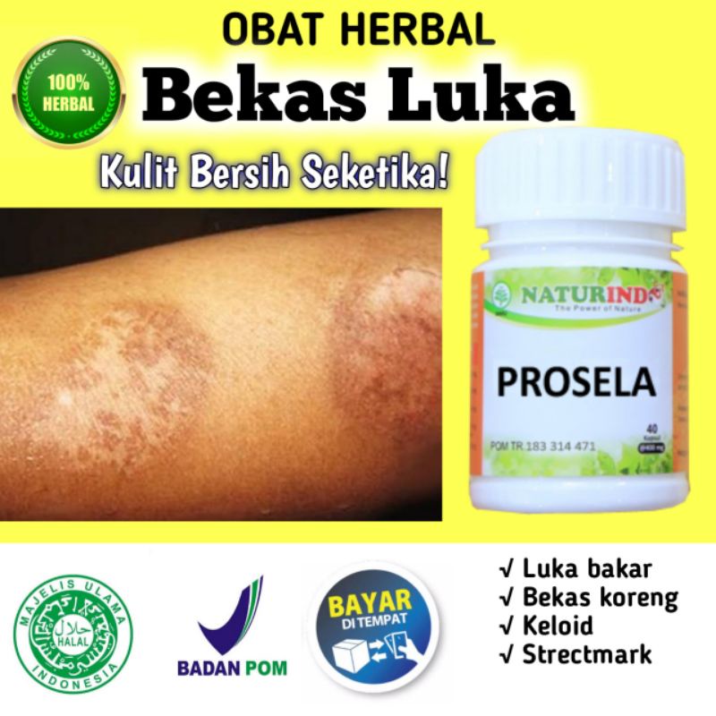 Obat Bekas Luka Bakar Ampuh Menghilangkan Korengan Dan Keloid memutihkan Kulit Menghitam strect mark