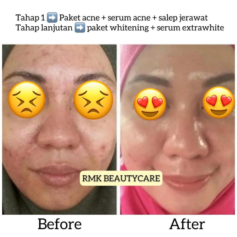 paket acne whitening cream jerawat radang jerawat bruntusan RMK