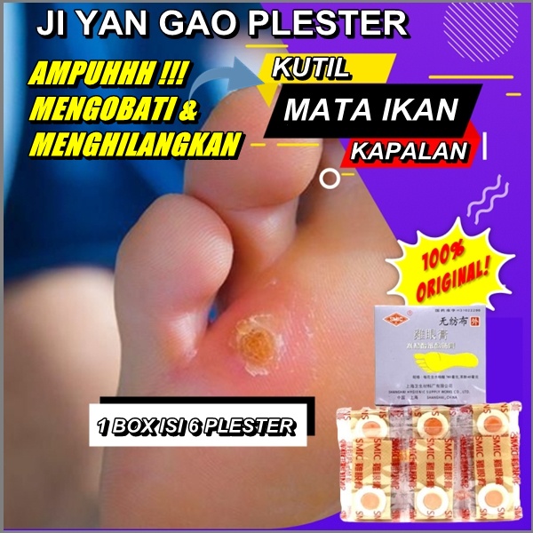 Plester Obat Kutil / Ji Yan Gao / Mata Ikan / Kapalan Box isi 6 Plester