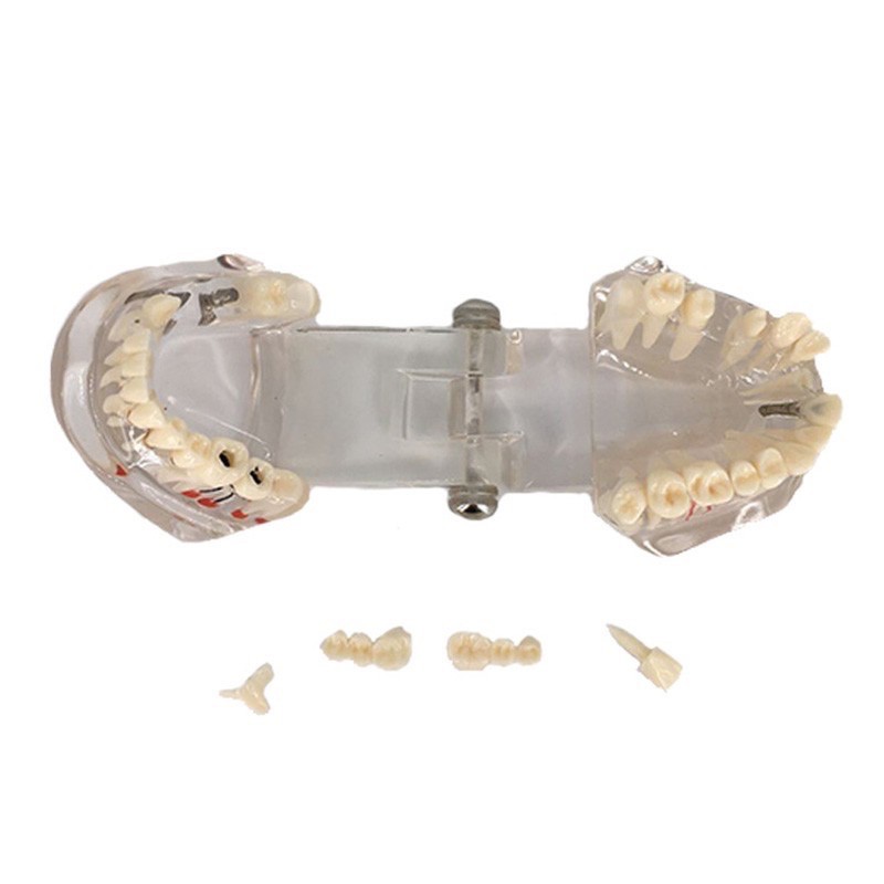 Dental Study Model Gigi Orthodontic Malocclusion PVC + Resin / Patung Gigi Phantom Bisa Di Lepas