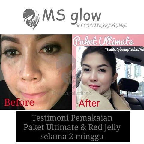 Ms Glow Paket Ultimate Menghilangkan Flek Mencerahkan Wajah Original Ms Glow Bpom Aman Termurah Shopee Indonesia