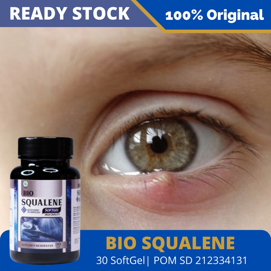 Obat Benjolan Di Kelopak Mata, Kalazion, Bintitan di Bawah Mata, Mata Bintitan, Bintitan Mata, Mata 