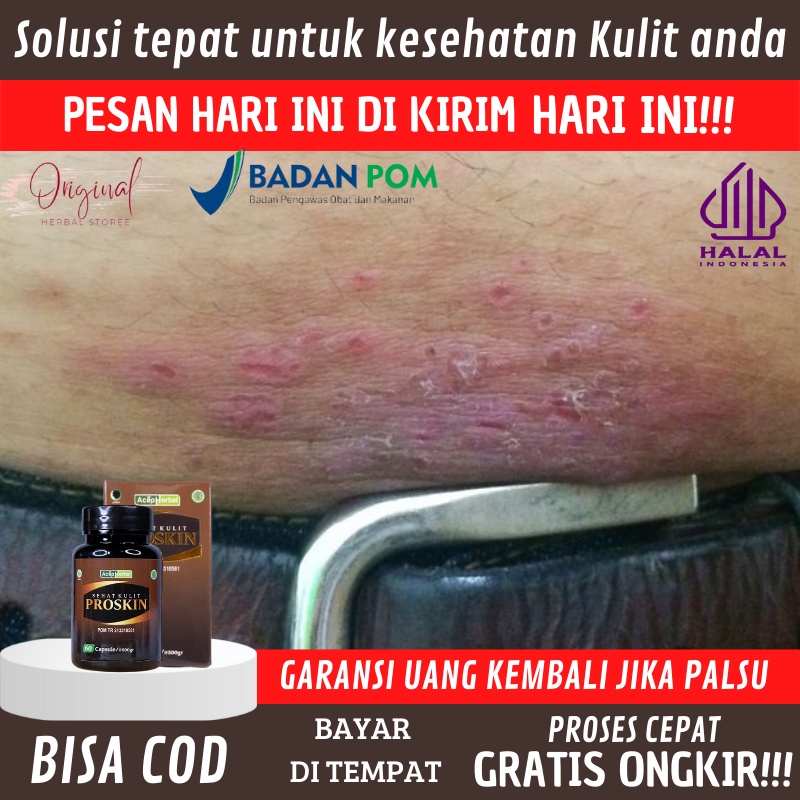 Obat  Lecet Kemaluan, Obat Lebam Merah di kelamin,  Penghilang gatal kelamin pria / wanita, Obat gat